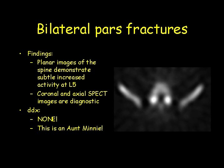 Bilateral pars fractures • Findings: – Planar images of the spine demonstrate subtle increased