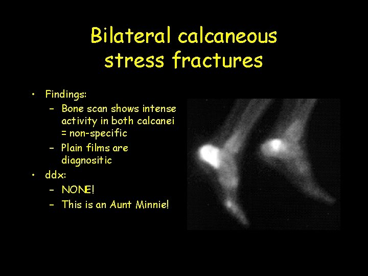Bilateral calcaneous stress fractures • Findings: – Bone scan shows intense activity in both