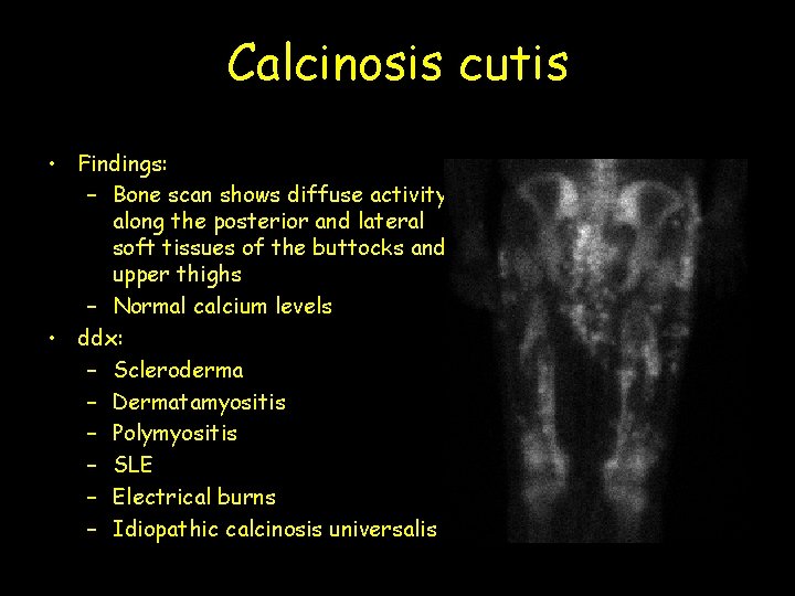 Calcinosis cutis • Findings: – Bone scan shows diffuse activity along the posterior and