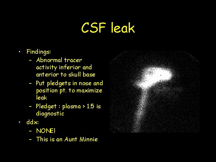 CSF leak • Findings: – Abnormal tracer activity inferior and anterior to skull base