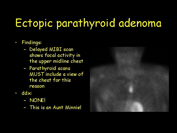 Ectopic parathyroid adenoma • Findings: – Delayed MIBI scan shows focal activity in the