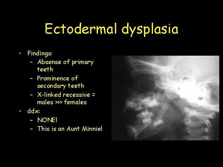 Ectodermal dysplasia • Findings: – Absense of primary teeth – Prominence of secondary teeth