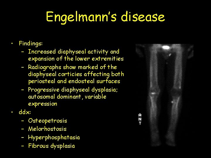 Engelmann’s disease • Findings: – Increased diaphyseal activity and expansion of the lower extremities