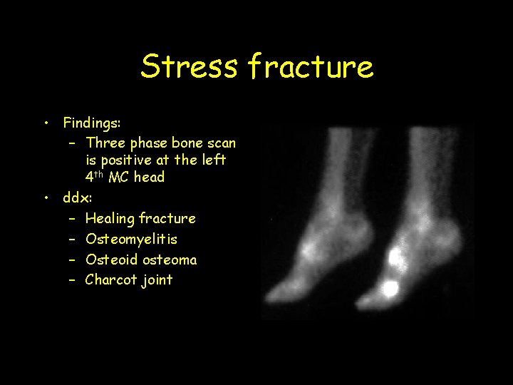 Stress fracture • Findings: – Three phase bone scan is positive at the left