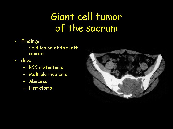 Giant cell tumor of the sacrum • Findings: – Cold lesion of the left