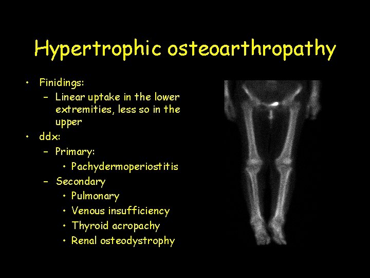 Hypertrophic osteoarthropathy • Finidings: – Linear uptake in the lower extremities, less so in