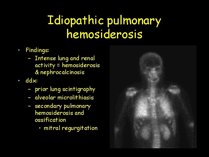 Idiopathic pulmonary hemosiderosis • Findings: – Intense lung and renal activity = hemosiderosis &