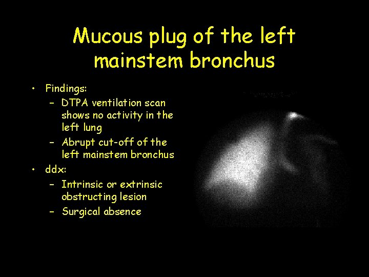 Mucous plug of the left mainstem bronchus • Findings: – DTPA ventilation scan shows