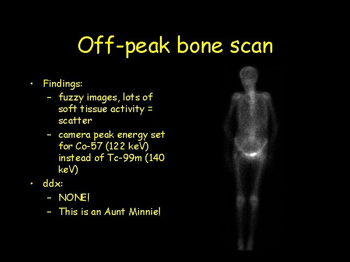 Off-peak bone scan • Findings: – fuzzy images, lots of soft tissue activity =