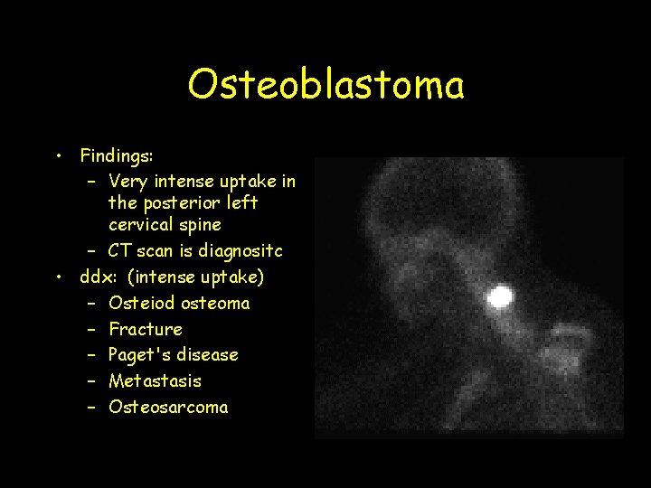 Osteoblastoma • Findings: – Very intense uptake in the posterior left cervical spine –