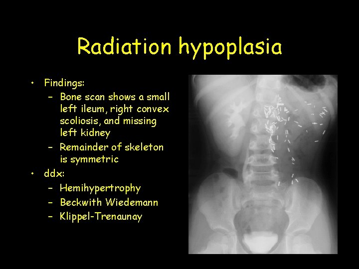 Radiation hypoplasia • Findings: – Bone scan shows a small left ileum, right convex