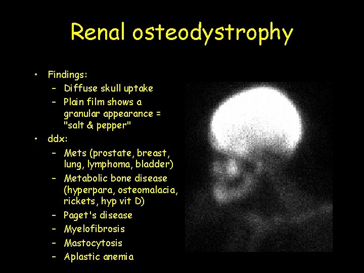 Renal osteodystrophy • Findings: – Diffuse skull uptake – Plain film shows a granular