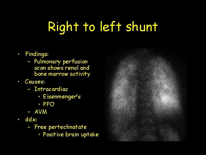 Right to left shunt • Findings: – Pulmonary perfusion scan shows renal and bone