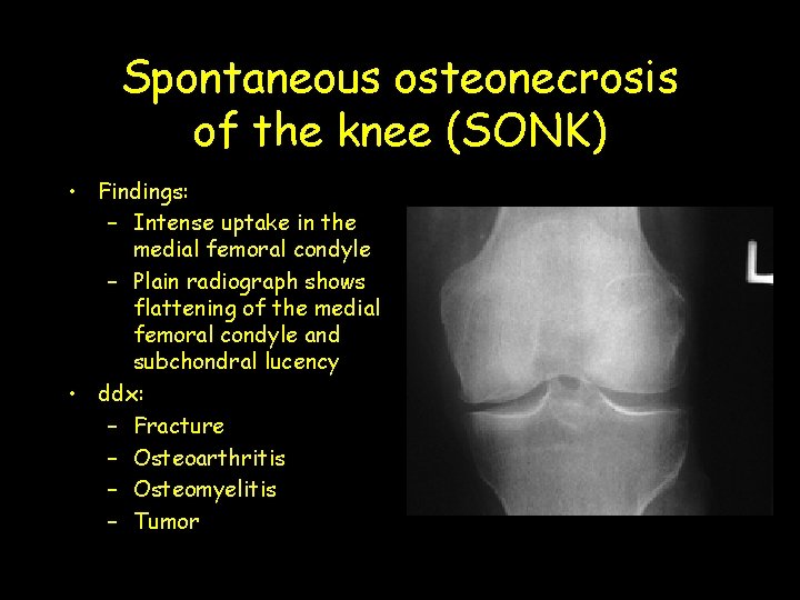 Spontaneous osteonecrosis of the knee (SONK) • Findings: – Intense uptake in the medial