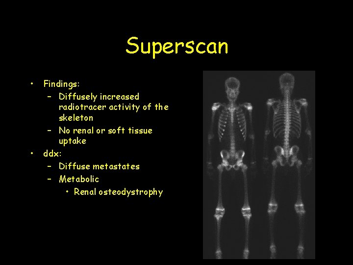 Superscan • • Findings: – Diffusely increased radiotracer activity of the skeleton – No