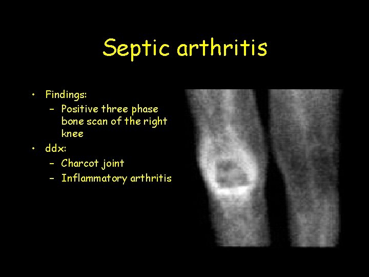 Septic arthritis • Findings: – Positive three phase bone scan of the right knee