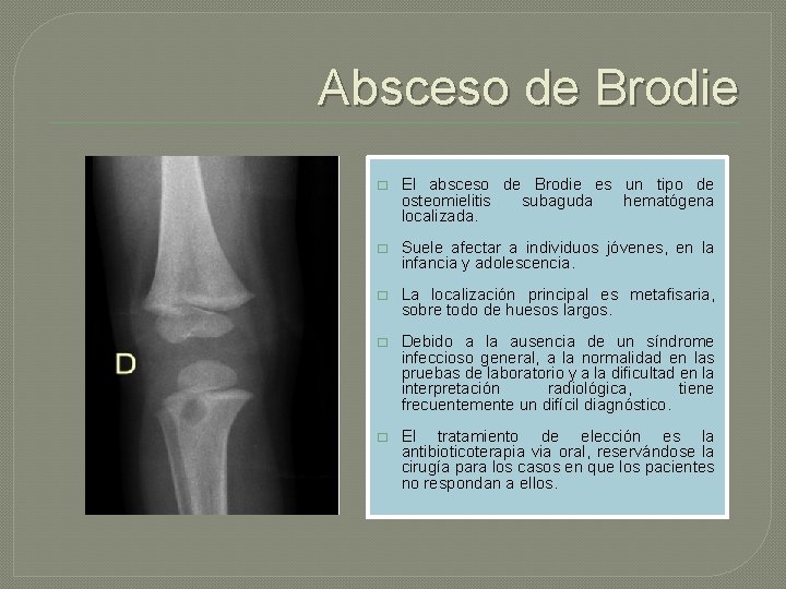 Absceso de Brodie � El absceso de Brodie es un tipo de osteomielitis subaguda