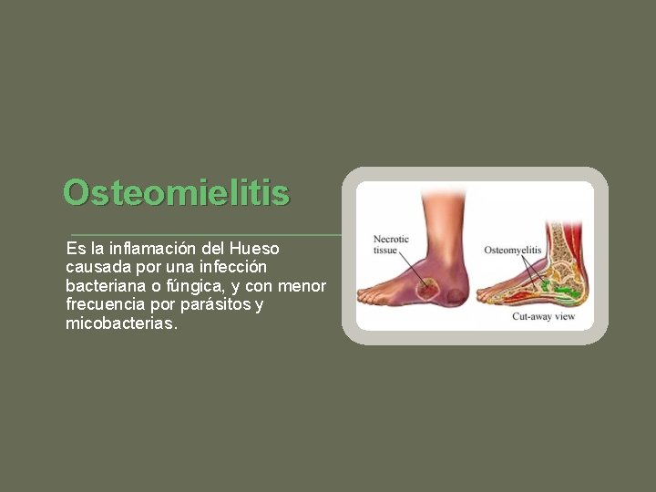 Osteomielitis Es la inflamación del Hueso causada por una infección bacteriana o fúngica, y