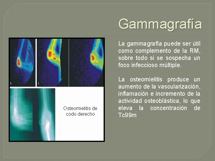 Gammagrafía Osteomielitis de codo derecho � La gammagrafía puede ser útil como complemento de