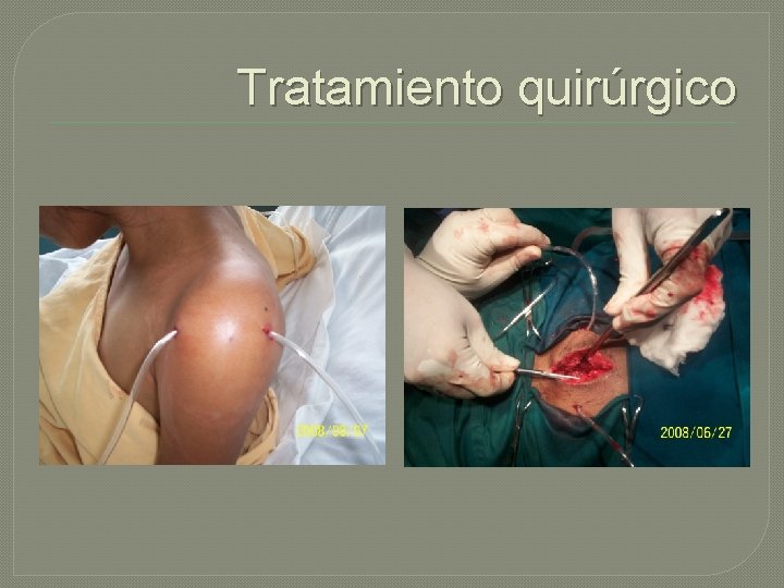 Tratamiento quirúrgico 