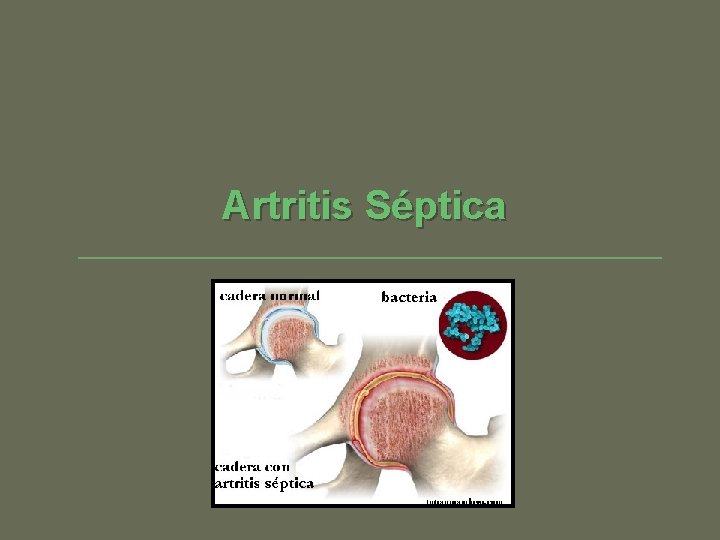 Artritis Séptica 