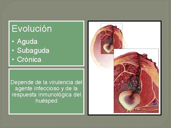Evolución • Aguda • Subaguda • Crónica Depende de la virulencia del agente infeccioso