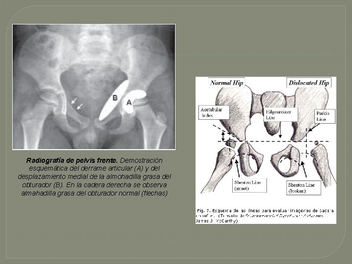 Radiografía de pelvis frente. Demostración esquemática del derrame articular (A) y del desplazamiento medial