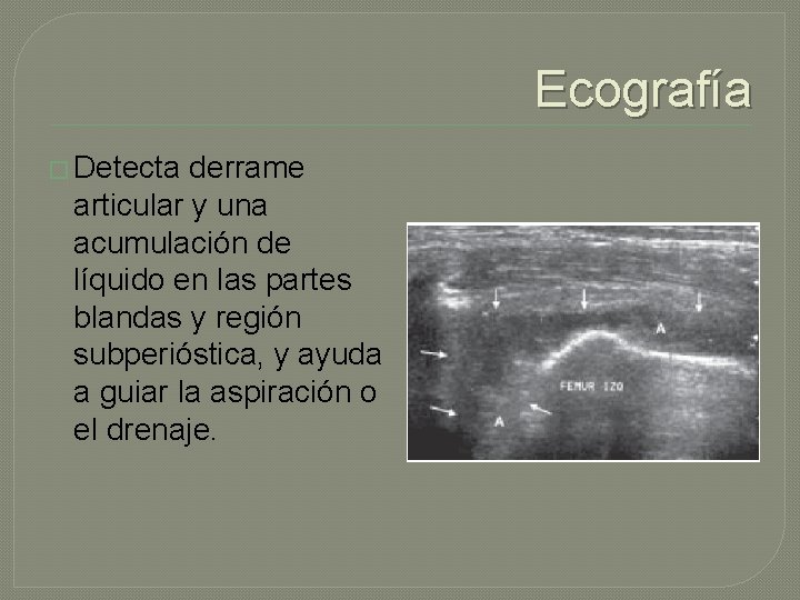 Ecografía � Detecta derrame articular y una acumulación de líquido en las partes blandas