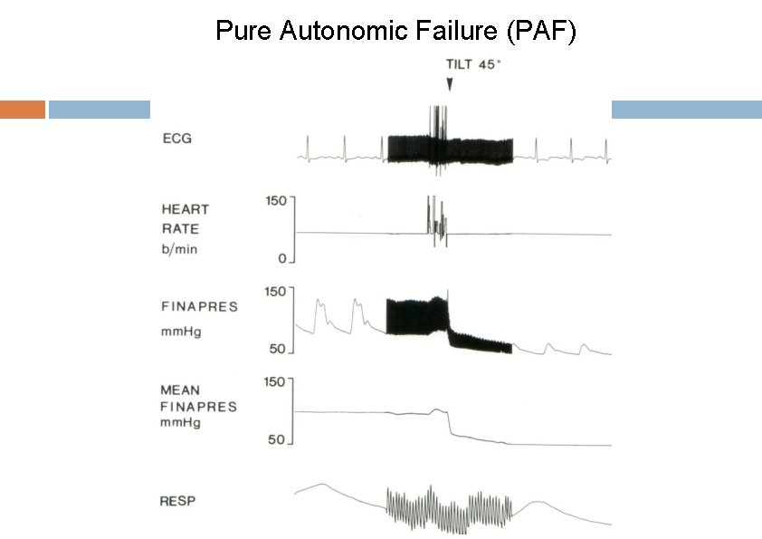 Pure Autonomic Failure (PAF) 