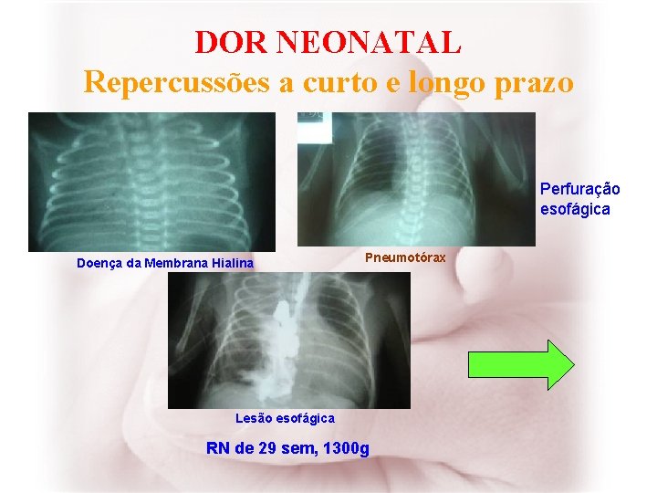 DOR NEONATAL Repercussões a curto e longo prazo Perfuração esofágica Doença da Membrana Hialina