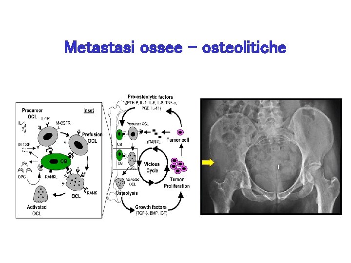 Metastasi ossee - osteolitiche 