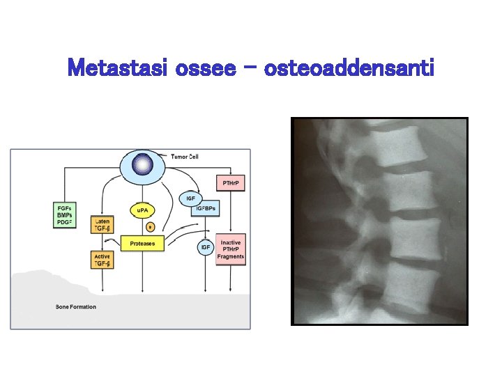 Metastasi ossee - osteoaddensanti 