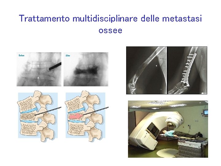 Trattamento multidisciplinare delle metastasi ossee 