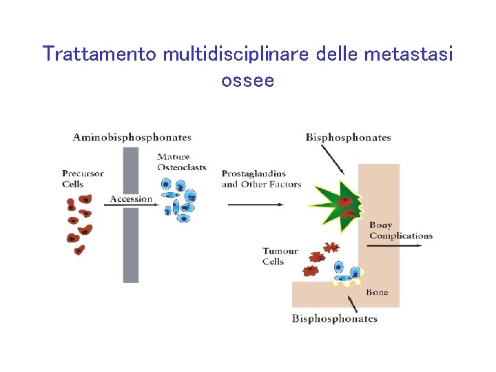 Trattamento multidisciplinare delle metastasi ossee 