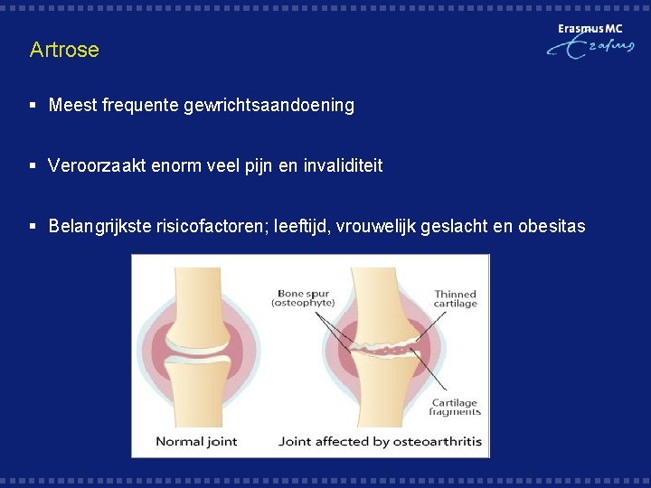 Artrose § Meest frequente gewrichtsaandoening § Veroorzaakt enorm veel pijn en invaliditeit § Belangrijkste