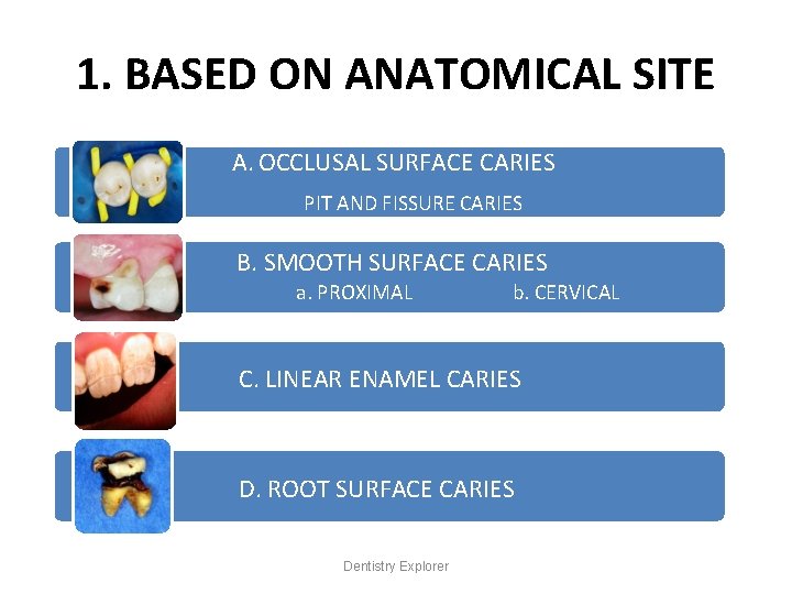 1. BASED ON ANATOMICAL SITE A. OCCLUSAL SURFACE CARIES PIT AND FISSURE CARIES B.