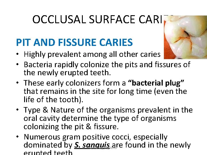OCCLUSAL SURFACE CARIES PIT AND FISSURE CARIES • Highly prevalent among all other caries