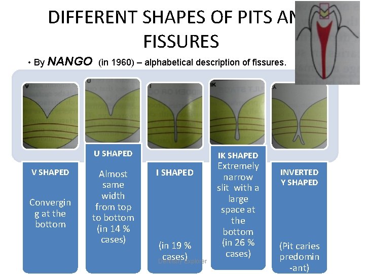 DIFFERENT SHAPES OF PITS AND FISSURES • By NANGO (in 1960) – alphabetical description