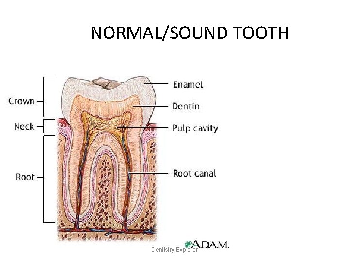 NORMAL/SOUND TOOTH Dentistry Explorer 