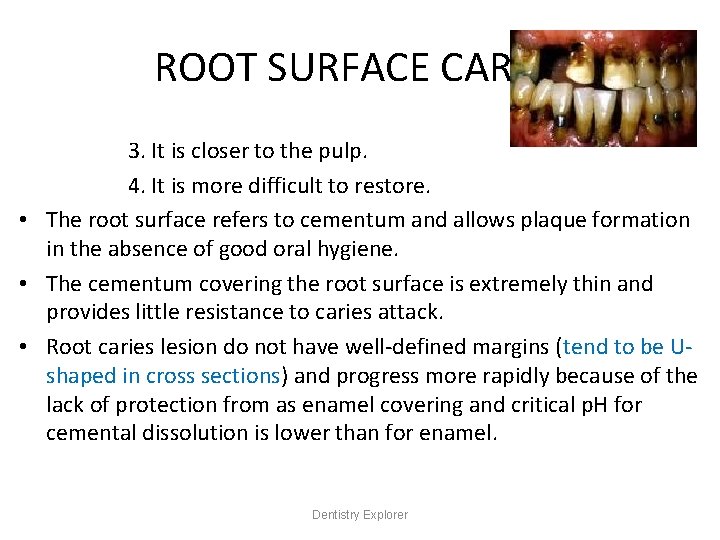 ROOT SURFACE CARIES 3. It is closer to the pulp. 4. It is more