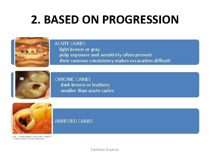 2. BASED ON PROGRESSION ACUTE CARIES light brown or gray pulp exposure and sensitivity