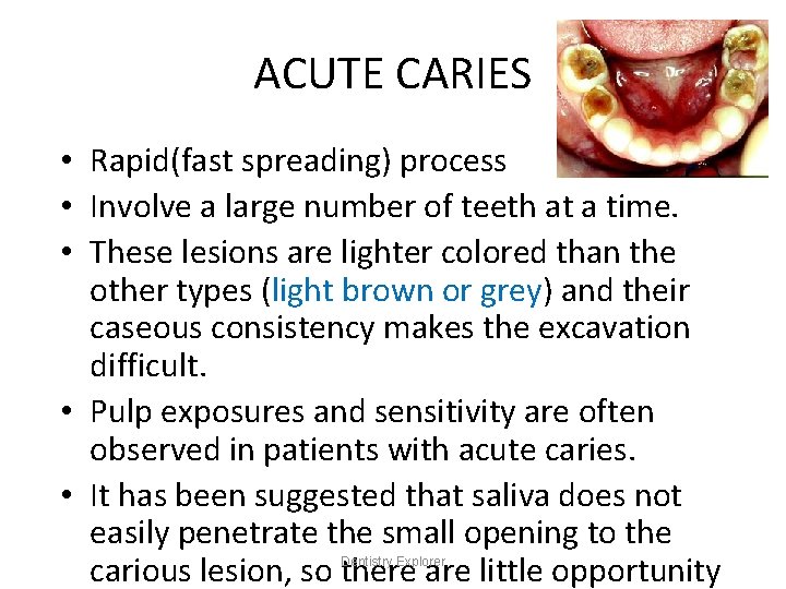 ACUTE CARIES • Rapid(fast spreading) process • Involve a large number of teeth at