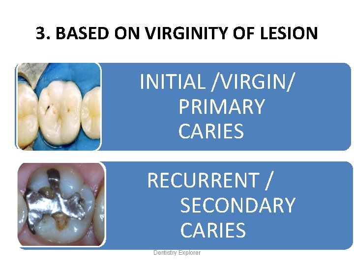 3. BASED ON VIRGINITY OF LESION INITIAL /VIRGIN/ PRIMARY CARIES RECURRENT / SECONDARY CARIES