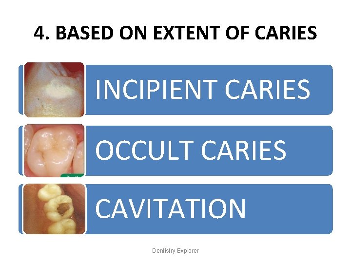 4. BASED ON EXTENT OF CARIES INCIPIENT CARIES OCCULT CARIES CAVITATION Dentistry Explorer 