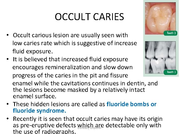 OCCULT CARIES • Occult carious lesion are usually seen with low caries rate which