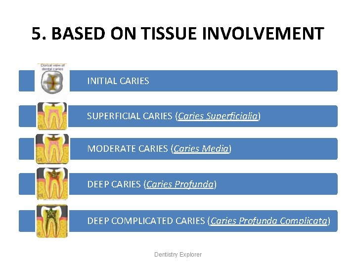 5. BASED ON TISSUE INVOLVEMENT INITIAL CARIES SUPERFICIAL CARIES (Caries Superficialia) MODERATE CARIES (Caries