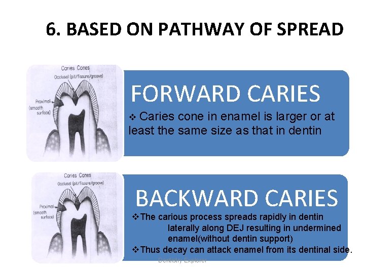 6. BASED ON PATHWAY OF SPREAD FORWARD CARIES v Caries cone in enamel is