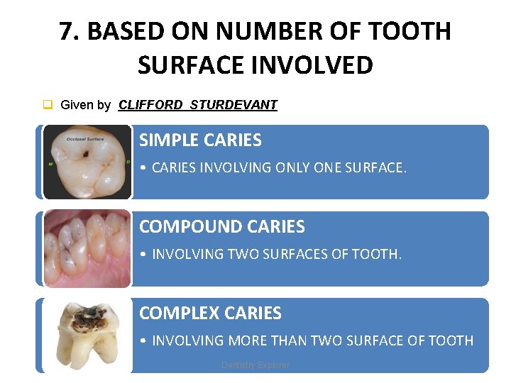 7. BASED ON NUMBER OF TOOTH SURFACE INVOLVED q Given by CLIFFORD STURDEVANT SIMPLE