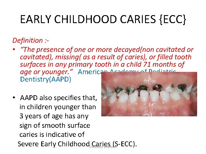EARLY CHILDHOOD CARIES {ECC} Definition : • “The presence of one or more decayed(non