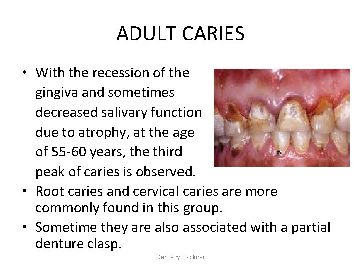 ADULT CARIES • With the recession of the gingiva and sometimes decreased salivary function